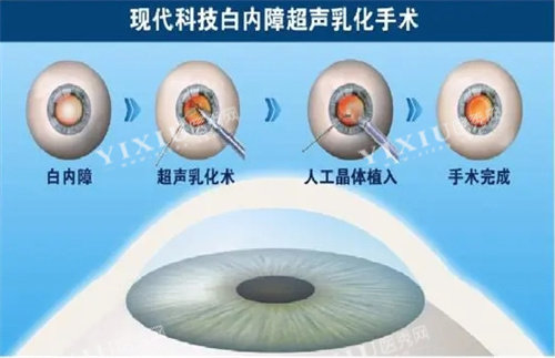 白内障眼科手术过程