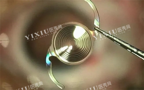 多焦点人工晶体