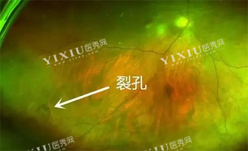 孔源性视网膜脱离裂孔部位