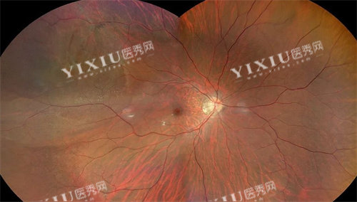 孔源性视网膜脱离放大图