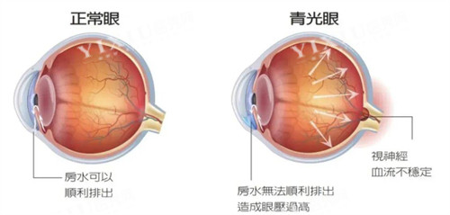 正常眼睛和青光眼的不同之处