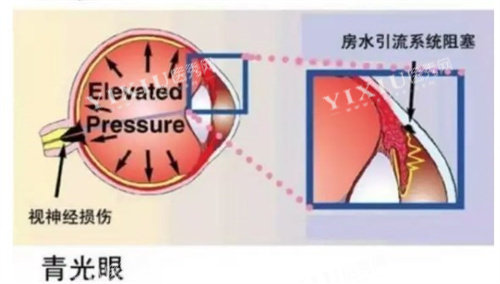 青光眼是什么原因导致的