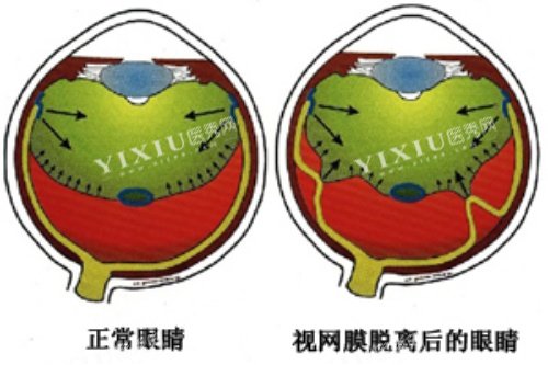 视网膜脱落卡通对比图
