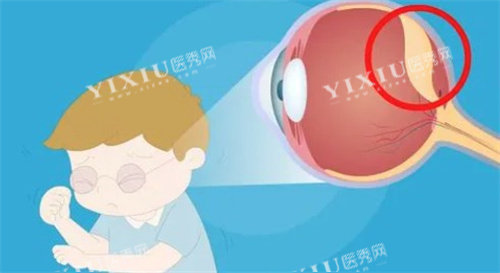 视网膜脱落