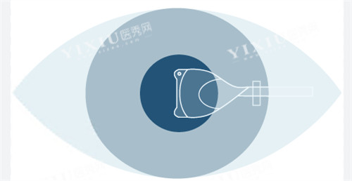 人工晶体植入手术图示
