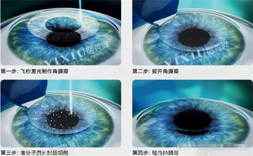 飞秒激光手术示意图