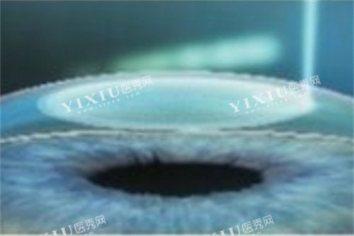 全飞秒激光