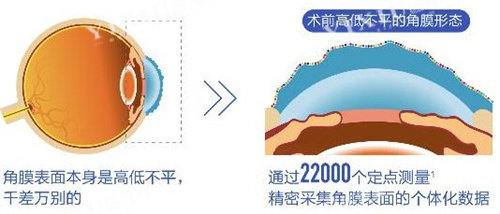 个性化飞秒术前