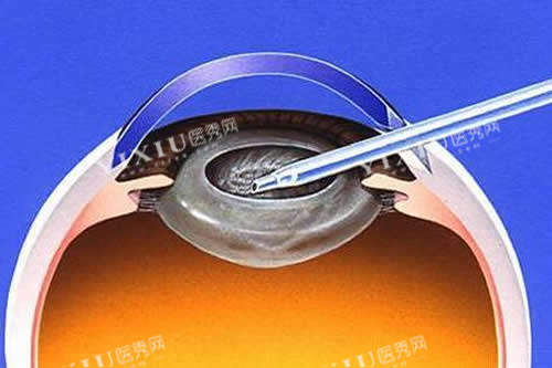 白内障手术卡通图