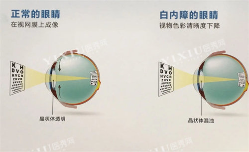 正常眼睛和白内障眼睛的对比图