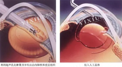 超声乳化白内障
