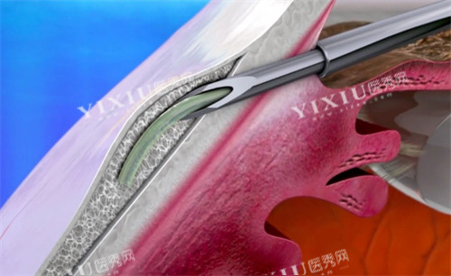 青光眼手术
