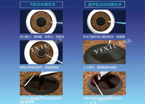 飞秒白内障手术过程图