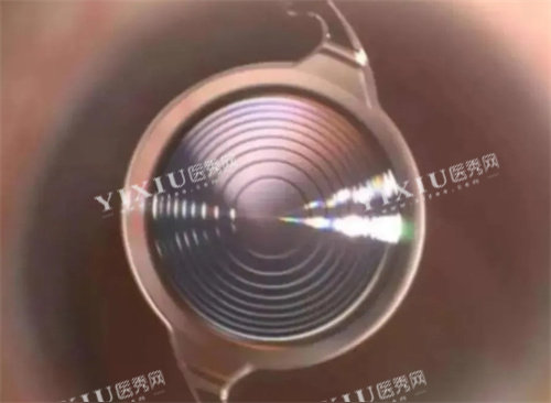 无极变焦人工晶体