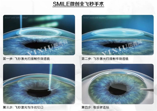 全飞秒手术过程