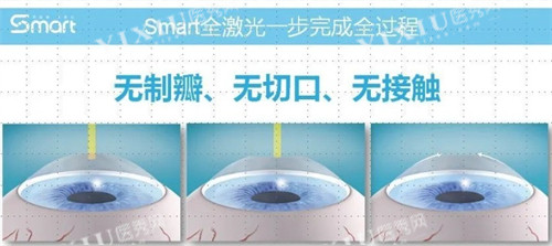 全激光优势