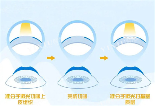 不同的近视手术