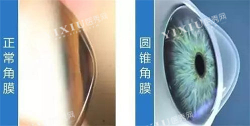 正常角膜与圆锥角膜图片