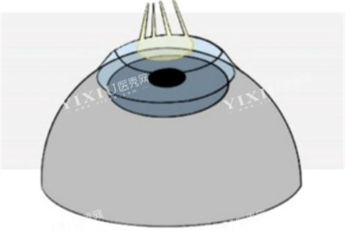 Refractive-Surgery-Techniques-1024x493_副本