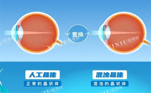 人工晶体置换示意图