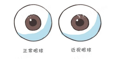 近视眼球照片