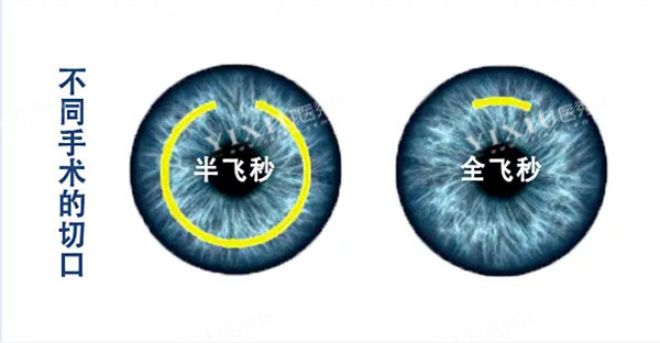 半飞秒和全飞秒区别