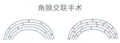 角膜交联手术