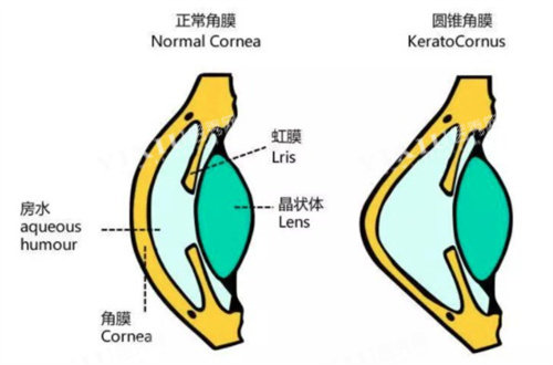 圆锥角膜和正常角膜动画