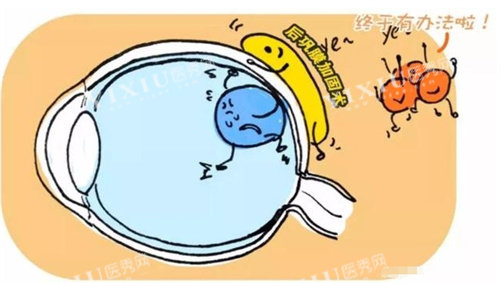 后巩膜加固术图片