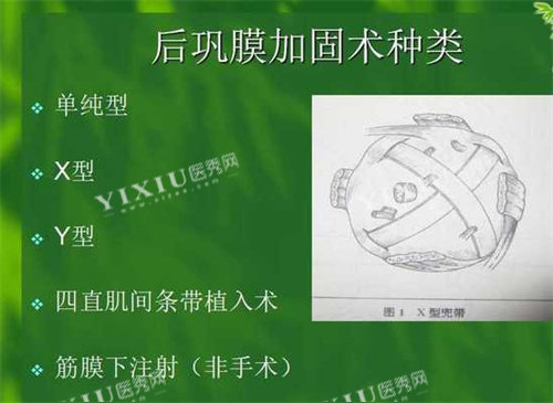 后巩膜加固术种类
