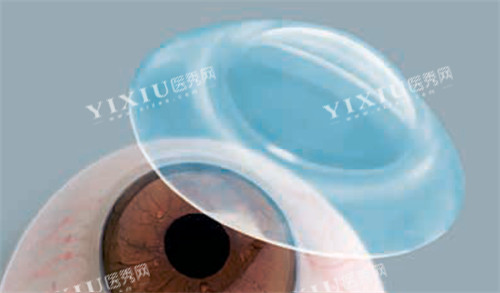 巩膜镜展示图