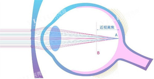 离焦镜片原理