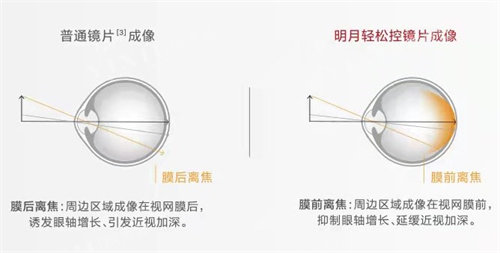 明月轻松控镜片成像