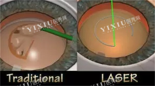 全飞秒手术操作过程图解