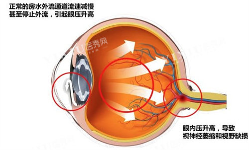 什么是急性闭角型青光眼