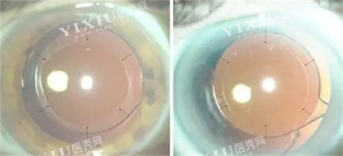 白内障