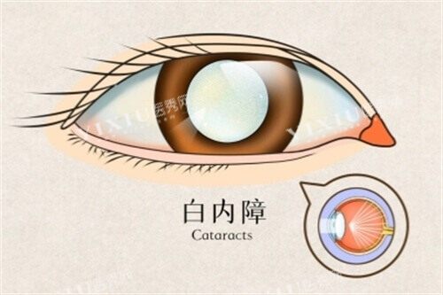 白内障卡通图