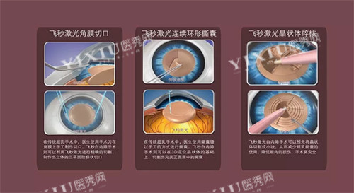 飞秒白内障手术流程