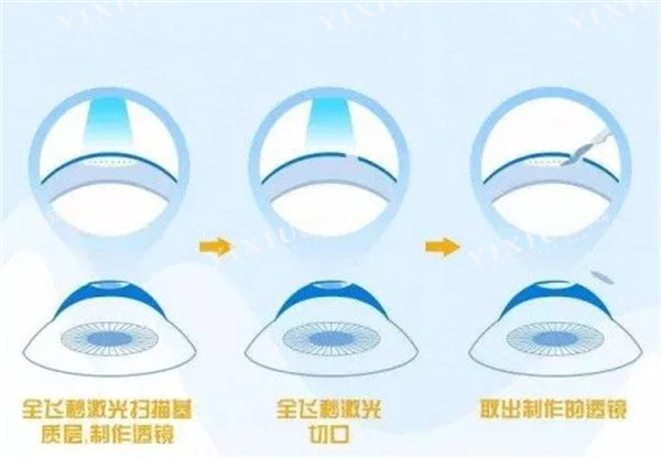 全飞秒激光眼睛照片