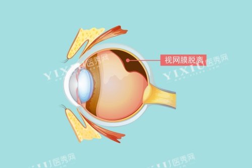 视网膜脱落图片展示