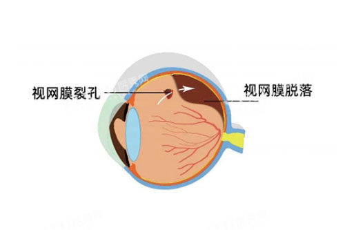视网膜脱落卡通图片展示