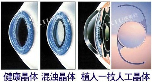 ICL晶体植入眼球对比示意图