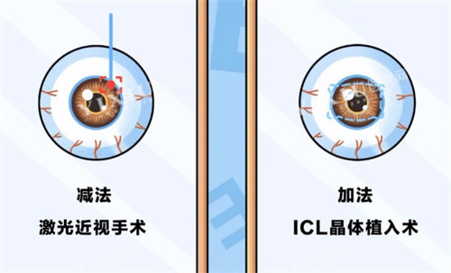 近视手术的分类
