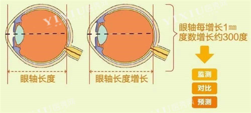 眼轴长度与近视