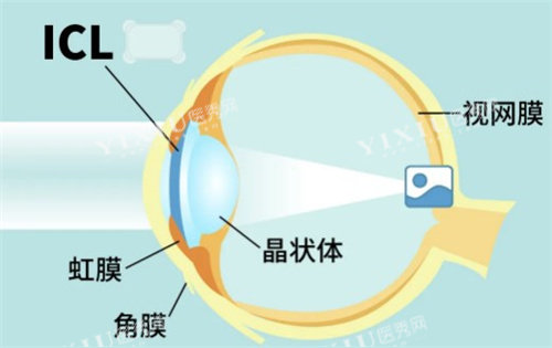 ICL植入卡通图
