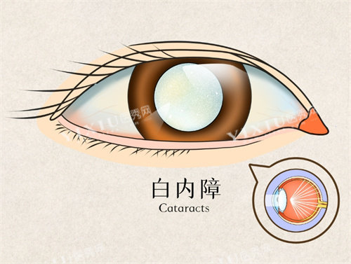 白内障手术图片