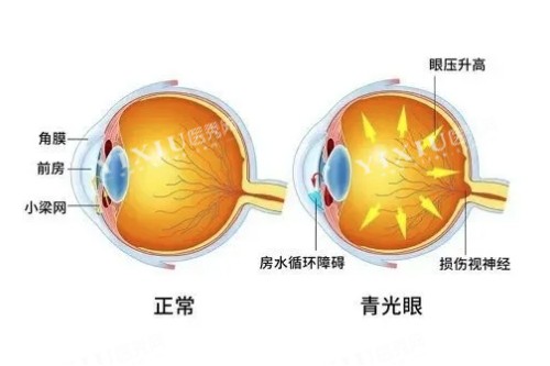 正常眼睛与青光眼概念对比图