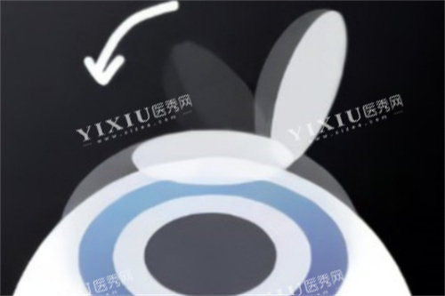 半飞秒盖回角膜瓣
