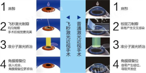 飞秒近视手术与激光近视手术的过程区别图解