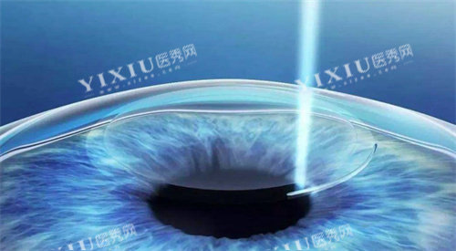 宁波华厦眼科做近视眼手术怎么样，分享2025年技术特点和收费标准！